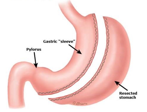 stomach stapled side effects